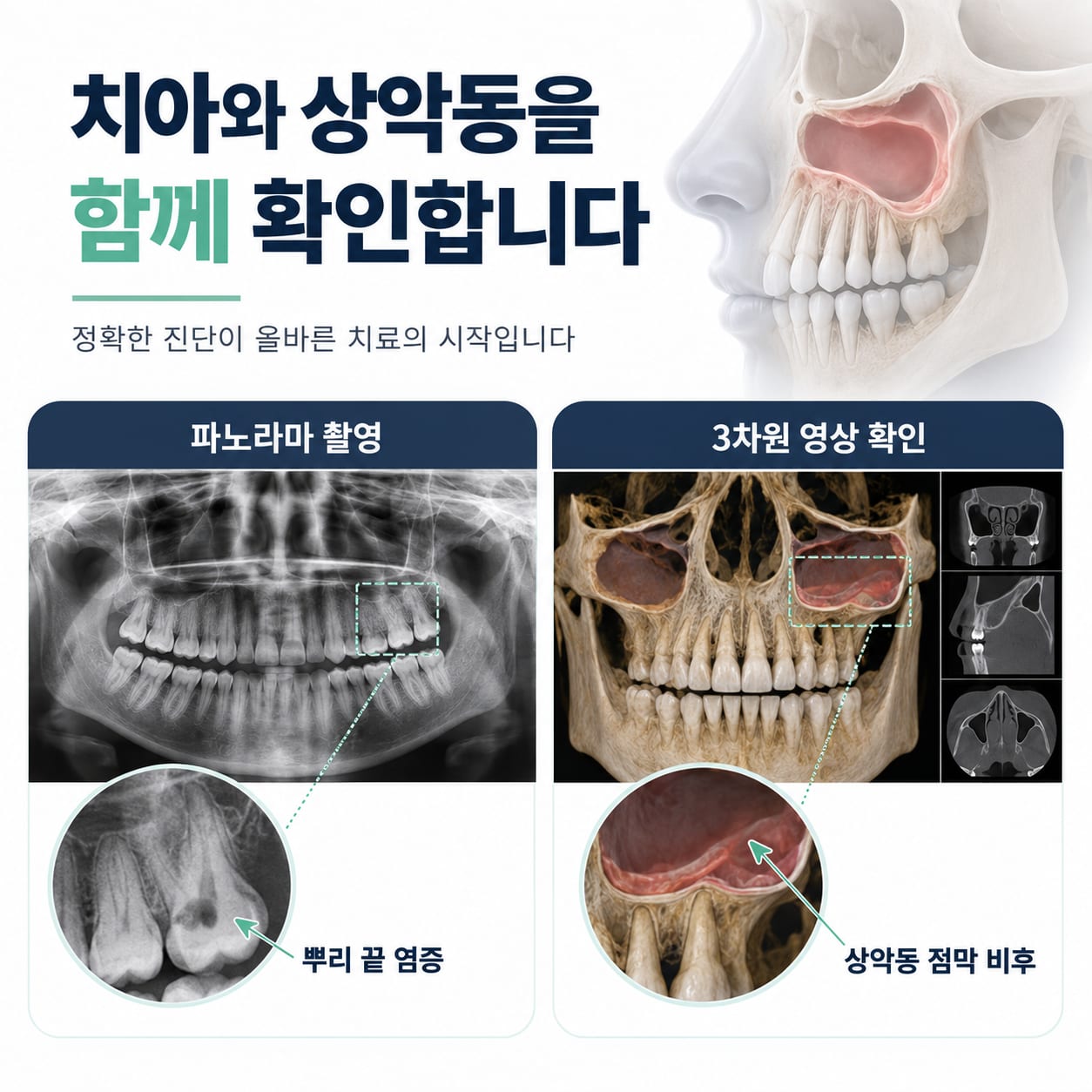 파노라마 촬영과 3D CT로 치성 상악동염을 진단하는 과정을 보여 주는 그림