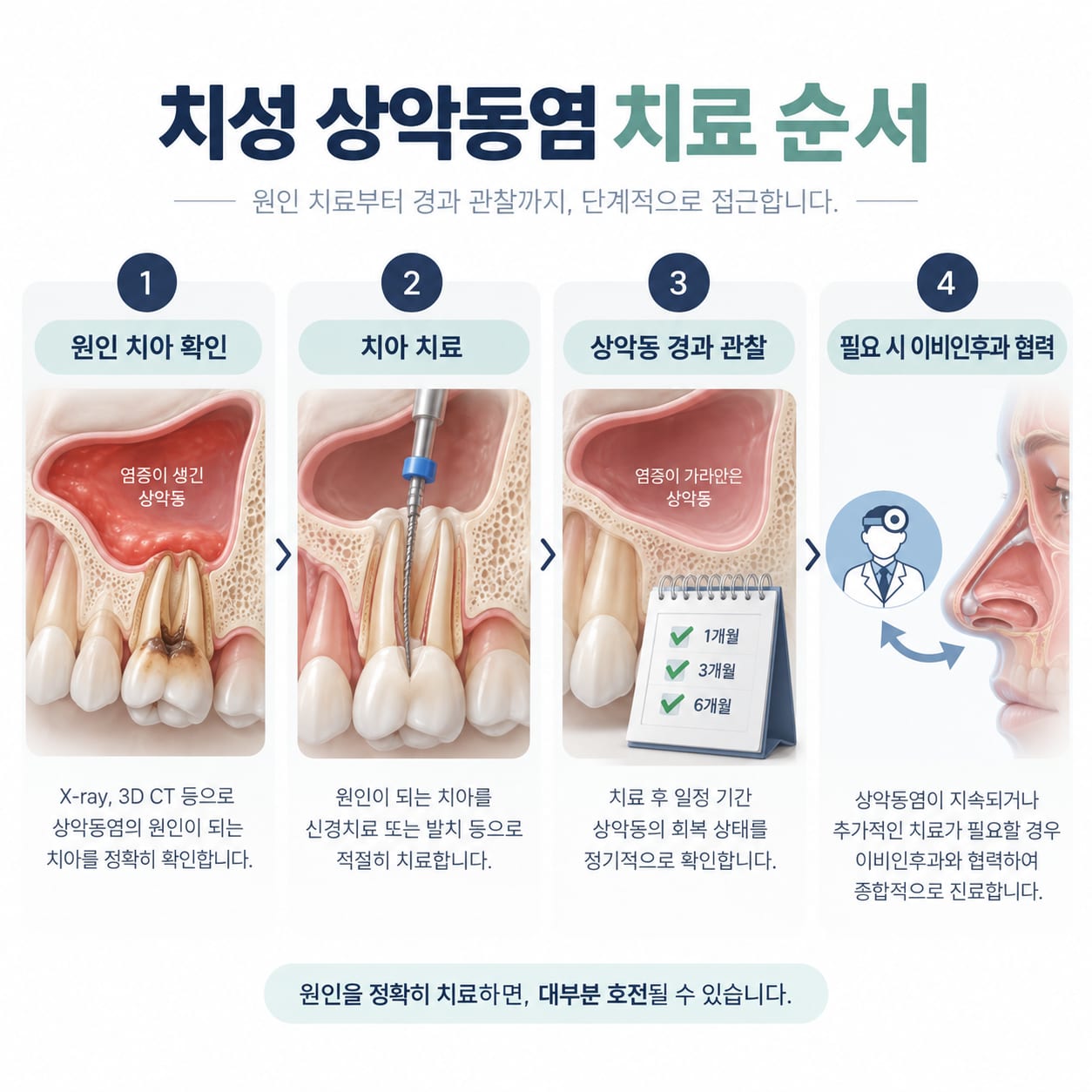 원인 치아 치료부터 이비인후과 협력까지 치성 상악동염의 치료 순서를 보여 주는 그림