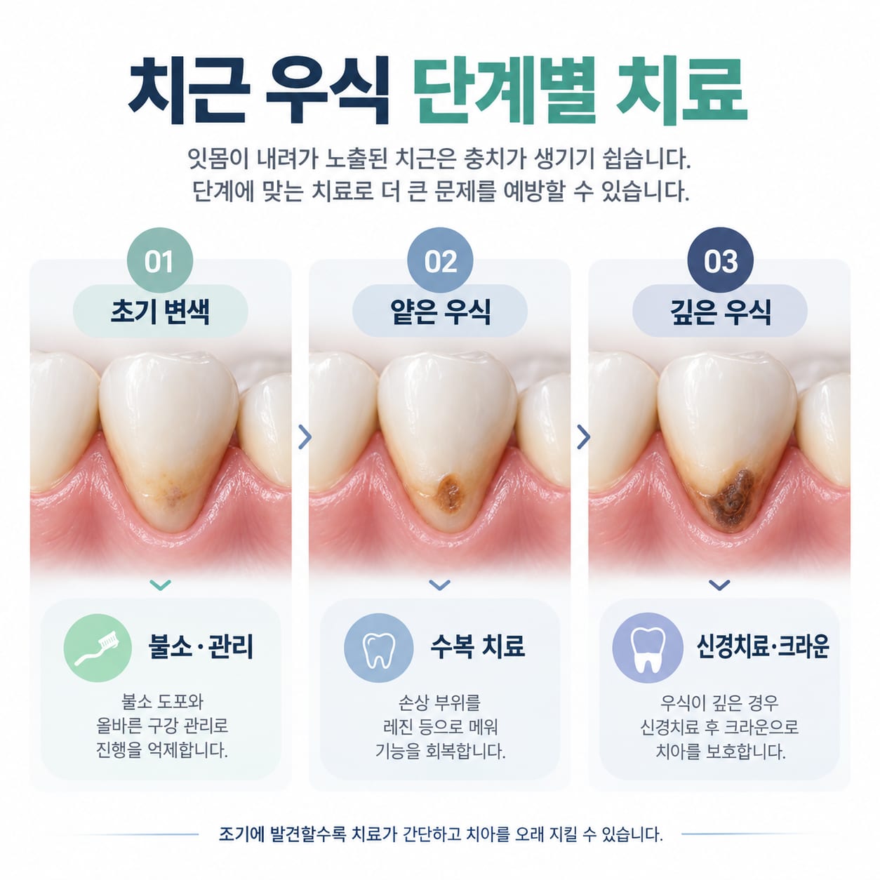 치근 우식의 초기 불소 도포부터 수복, 신경치료까지 단계별 치료를 정리한 그림
