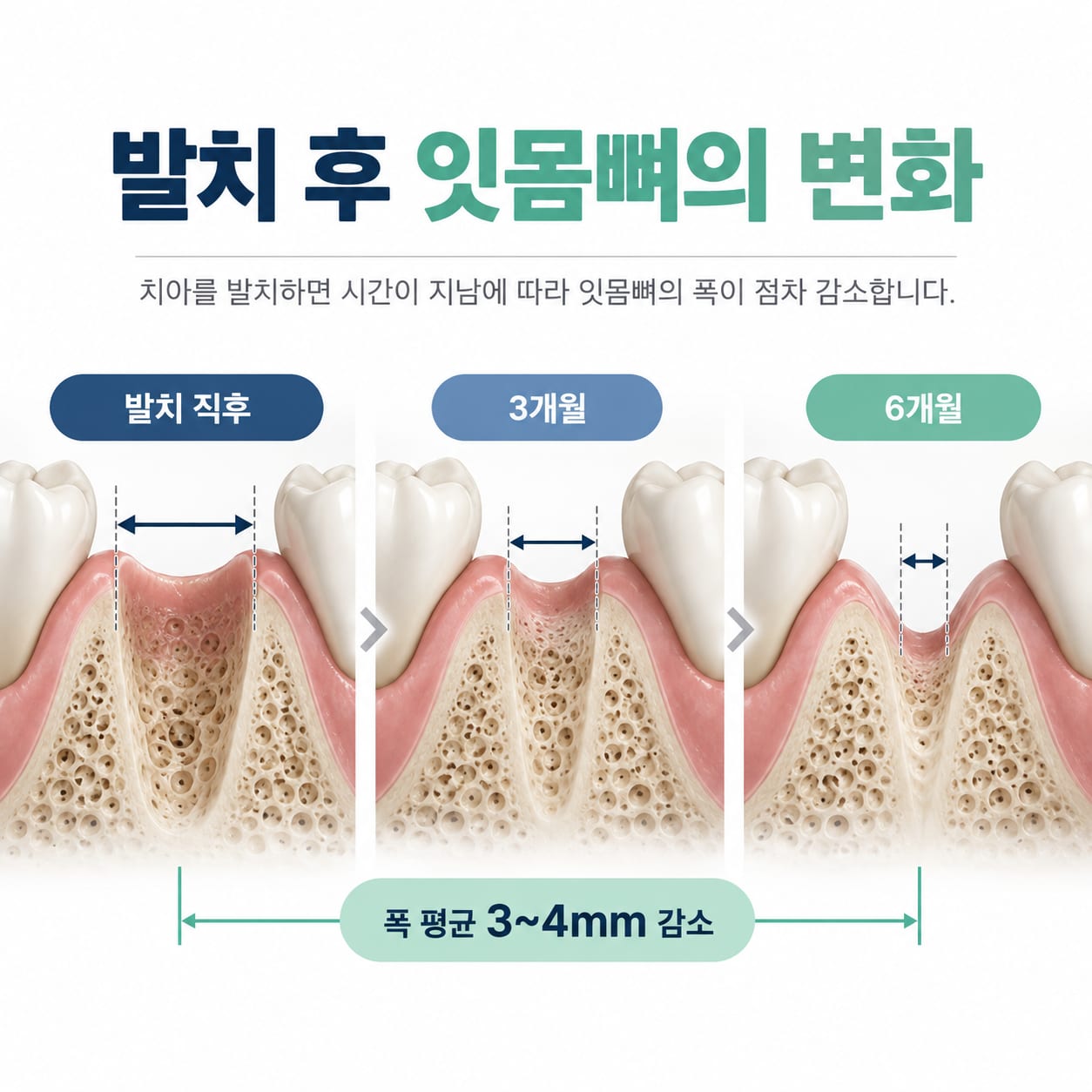 발치 후 6개월간 잇몸뼈 폭이 줄어드는 변화를 단계별로 보여 주는 그림