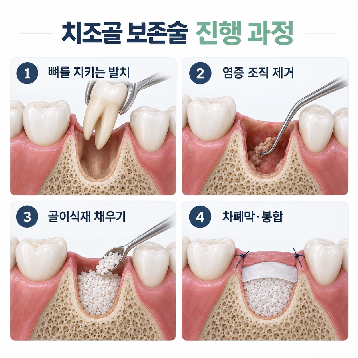 발치, 염증 제거, 골이식재 충전, 차폐막 봉합으로 이어지는 치조골 보존술 과정을 보여 주는 그림