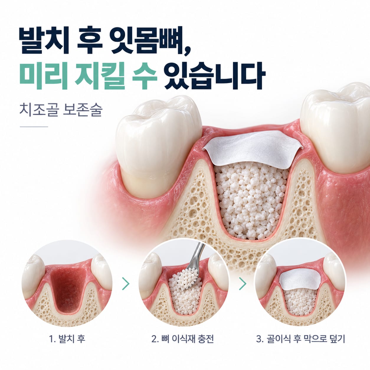 발치 후 골이식재와 차폐막으로 잇몸뼈를 지키는 치조골 보존술 과정을 설명하는 이미지
