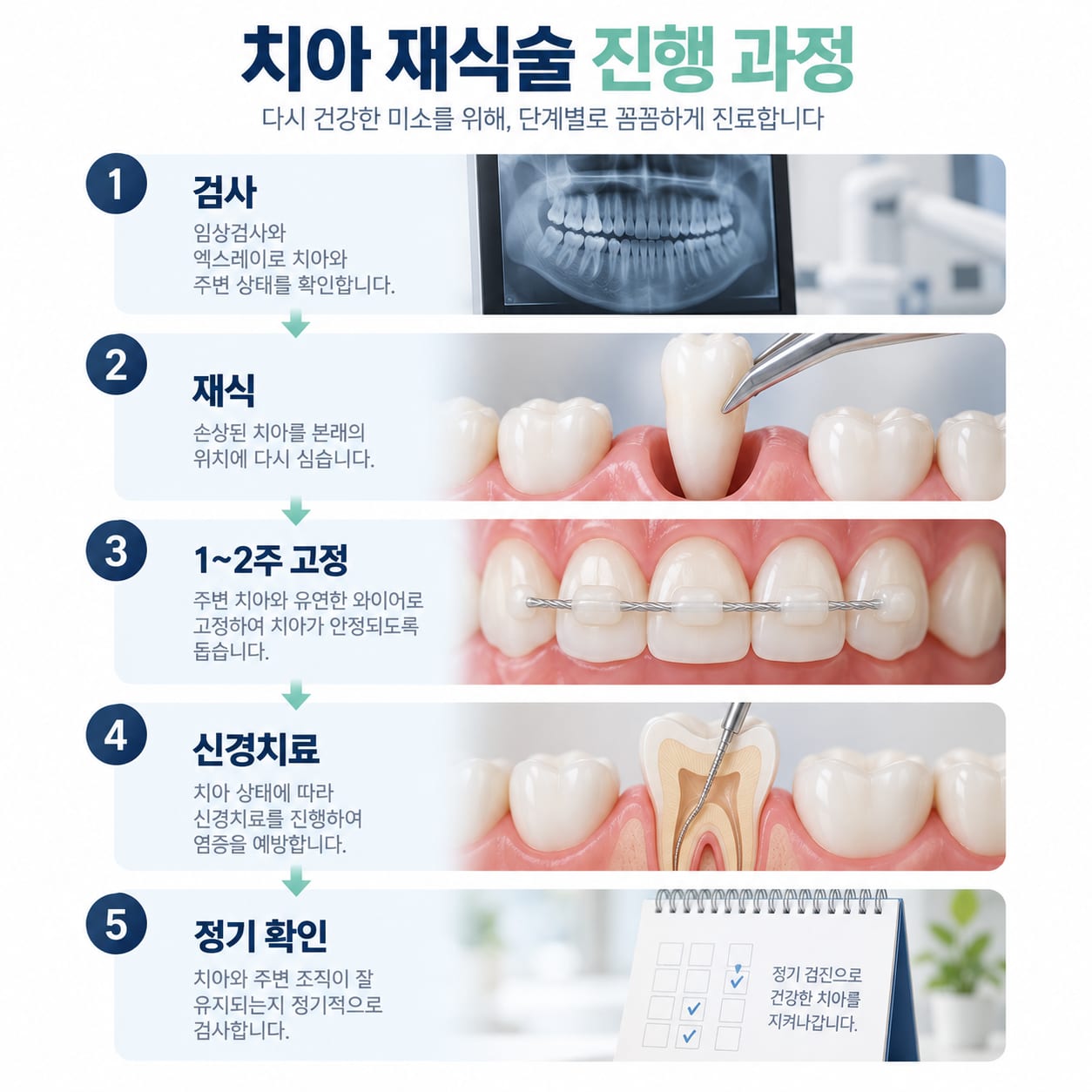 치아 재식술의 진단·세척·고정·신경치료 순서를 단계별로 보여 주는 그림