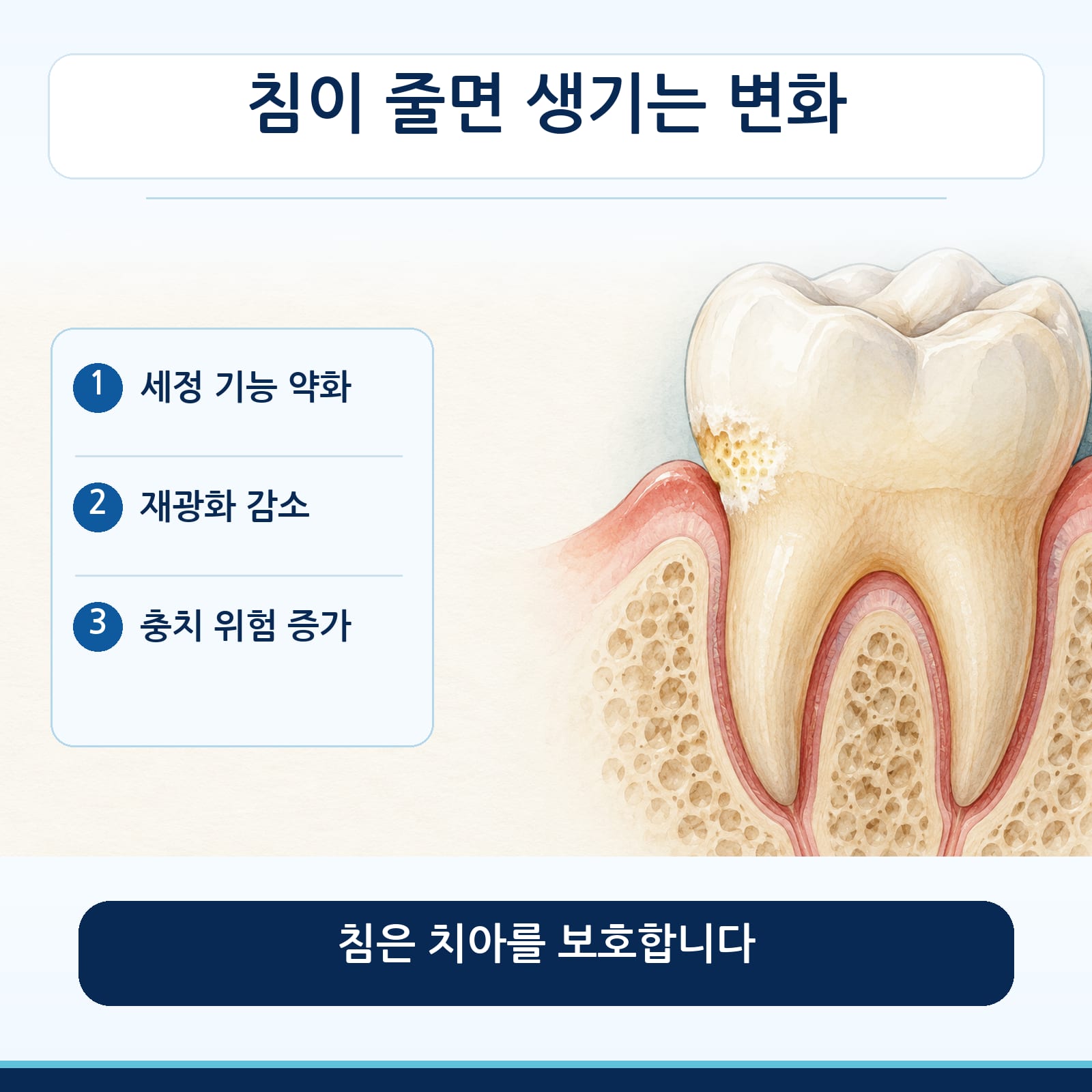 침이 줄면 세정 기능과 재광화가 약해져 충치 위험이 커지는 변화를 설명하는 그림