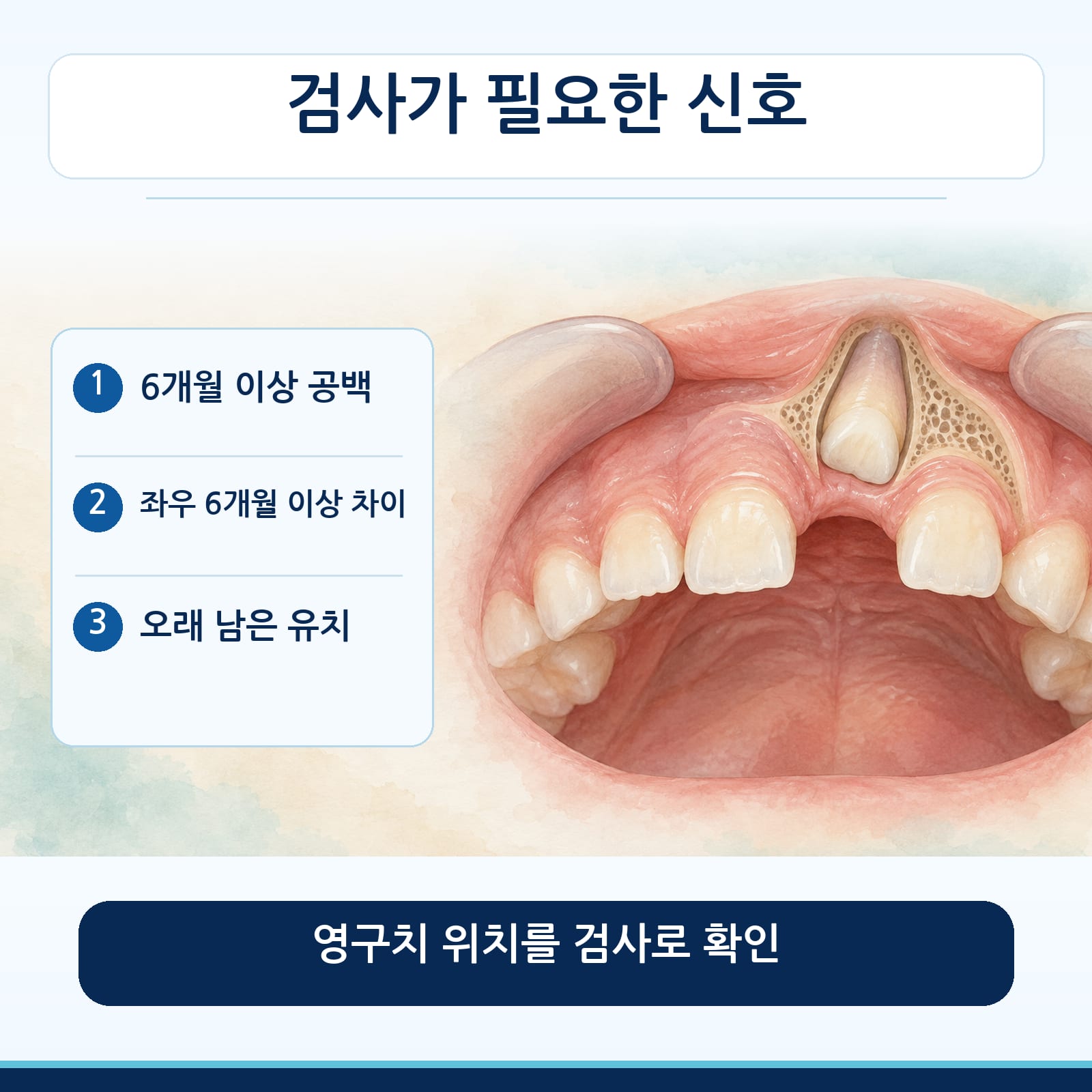 영구치 검사가 필요한 신호인 6개월 이상 공백, 좌우 6개월 이상 차이, 오래 남은 유치를 정리한 그림