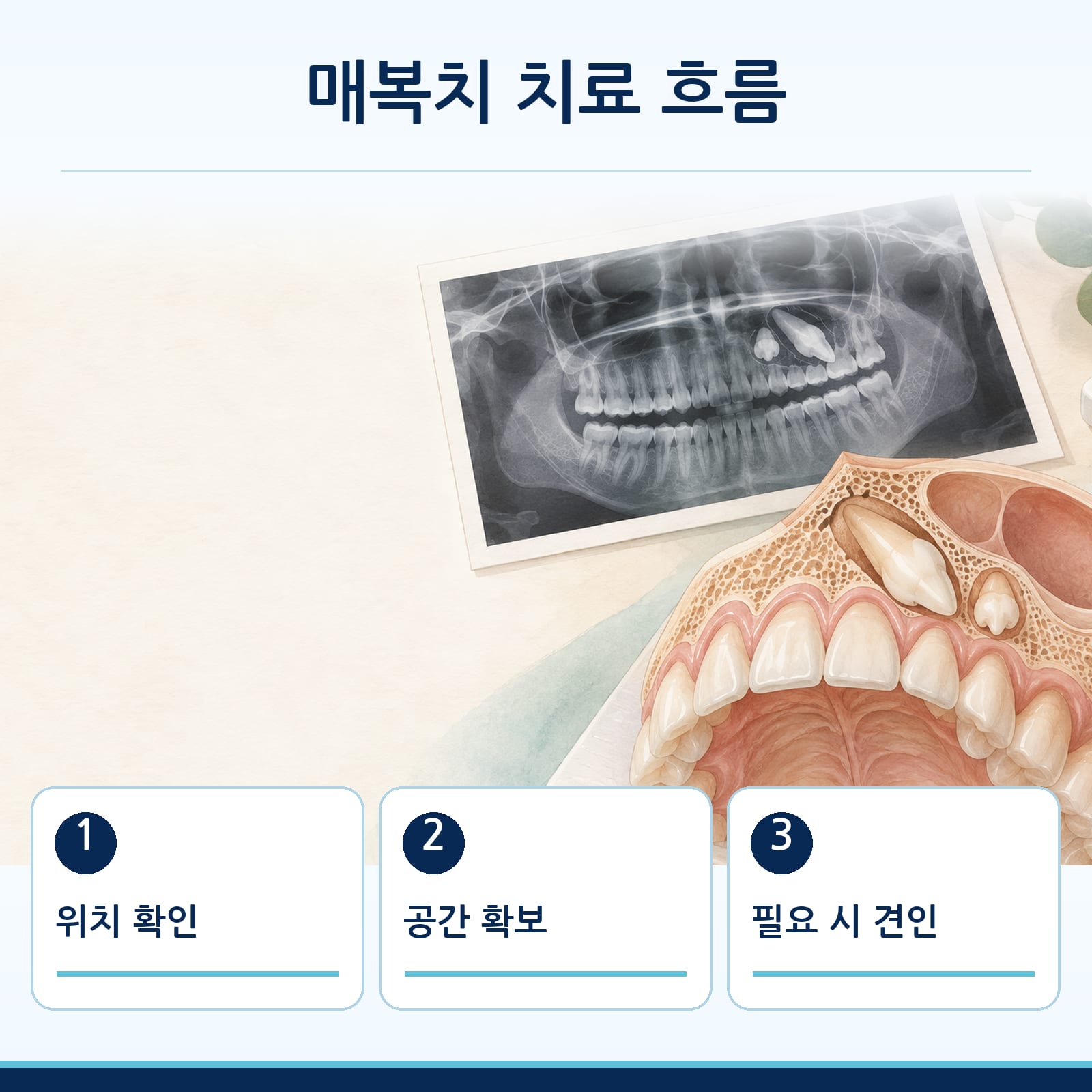 위치 확인, 공간 확보, 필요 시 견인으로 이어지는 매복치 치료 흐름을 나타낸 그림