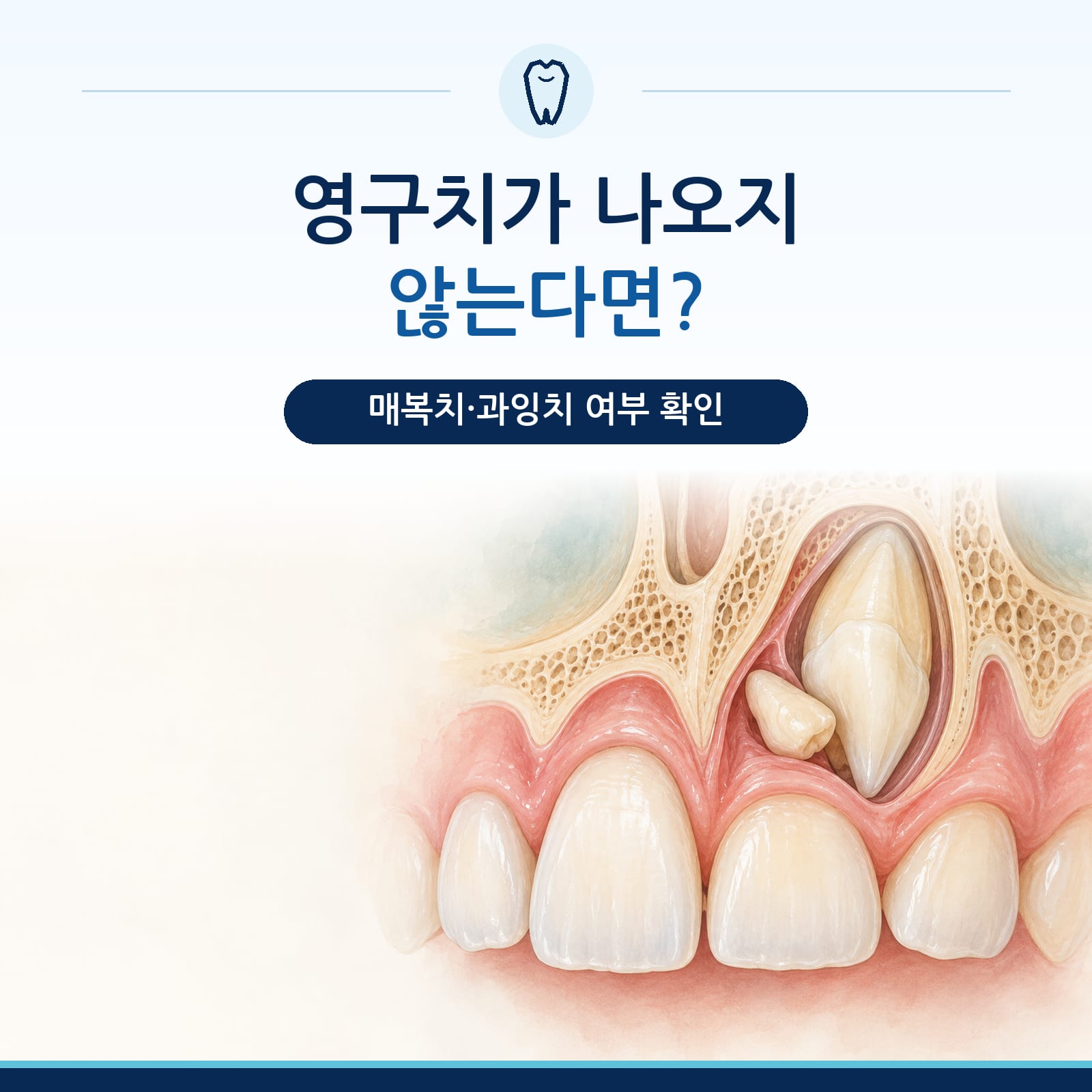 매복치와 과잉치의 진단 과정을 설명하는 삼송역 치과 칼럼 대표 이미지