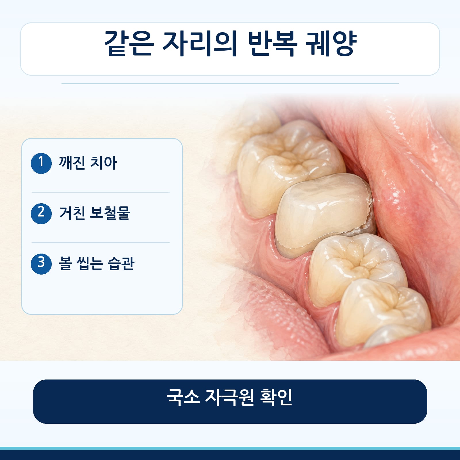 같은 자리에 반복되는 구내염의 국소 자극원인 깨진 치아, 거친 보철물, 볼 씹는 습관을 정리한 그림