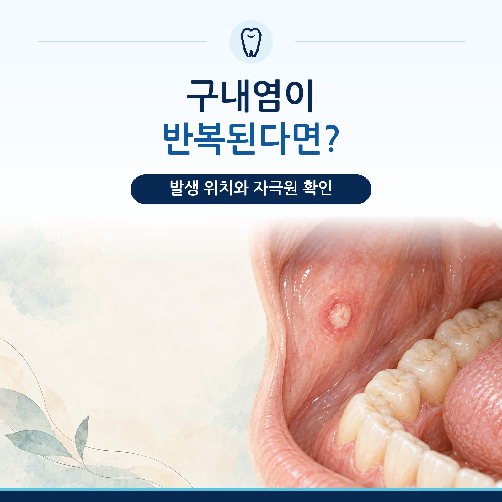재발성 아프타성 구내염의 원인과 관리를 설명하는 구파발역 치과 칼럼 대표 이미지