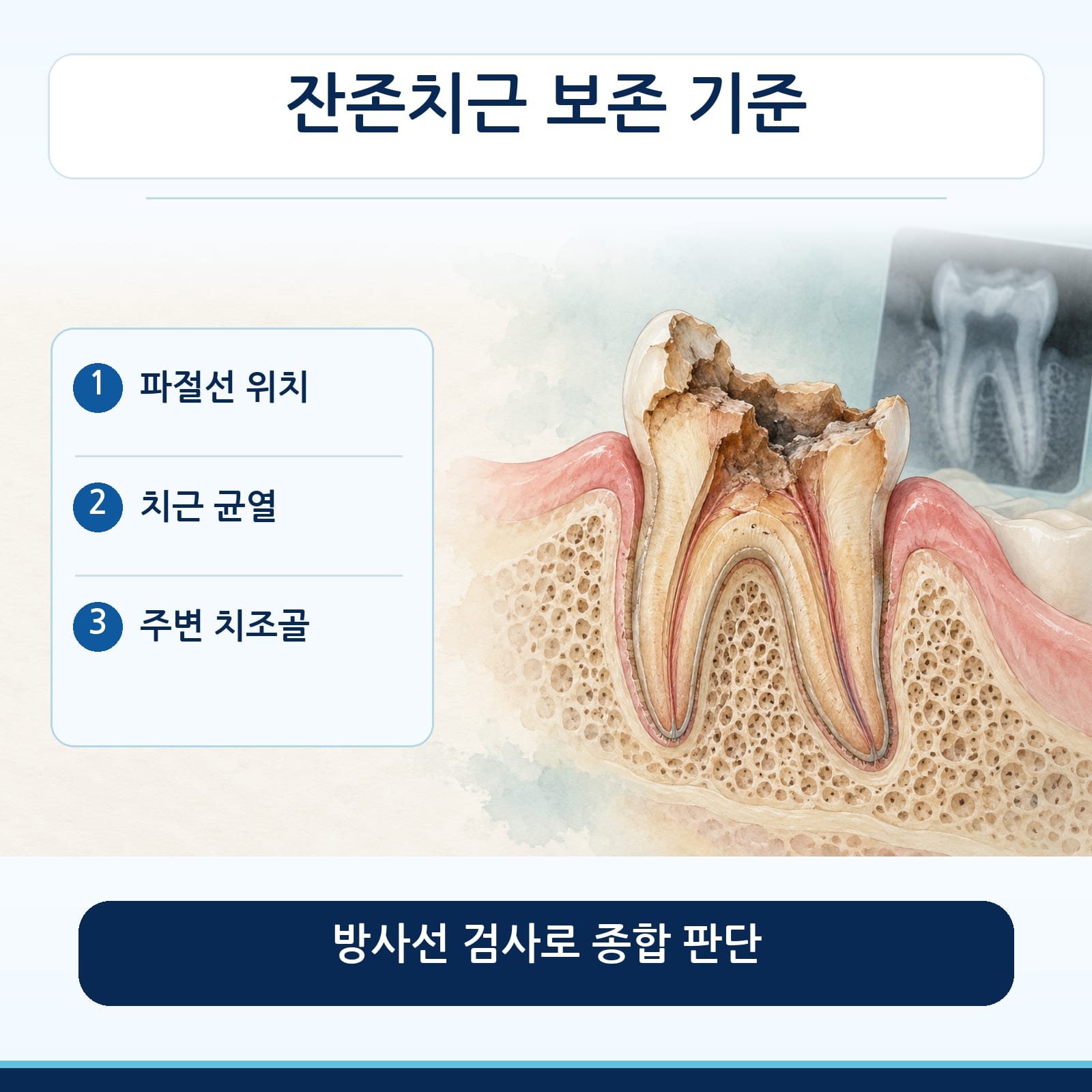 잔존치근 보존 여부를 판단하는 기준인 파절선 위치, 치근 균열, 주변 치조골을 정리한 그림