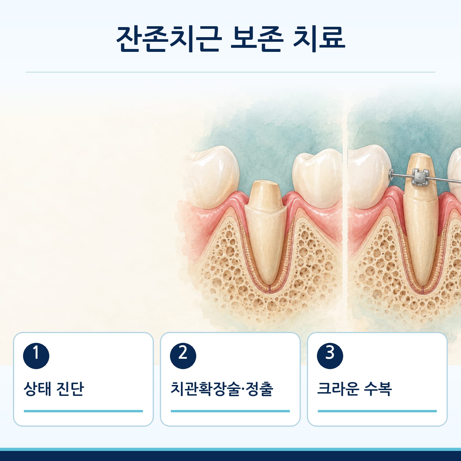 상태 진단, 치관확장술·정출, 크라운 수복으로 이어지는 잔존치근 보존 치료 순서를 나타낸 그림