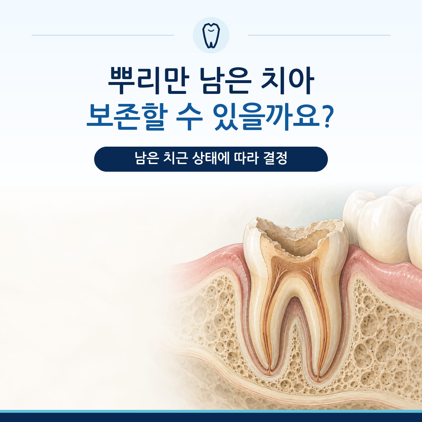 잔존치근 보존 치료의 진단 기준과 과정을 안내하는 지축동 치과 칼럼 대표 이미지