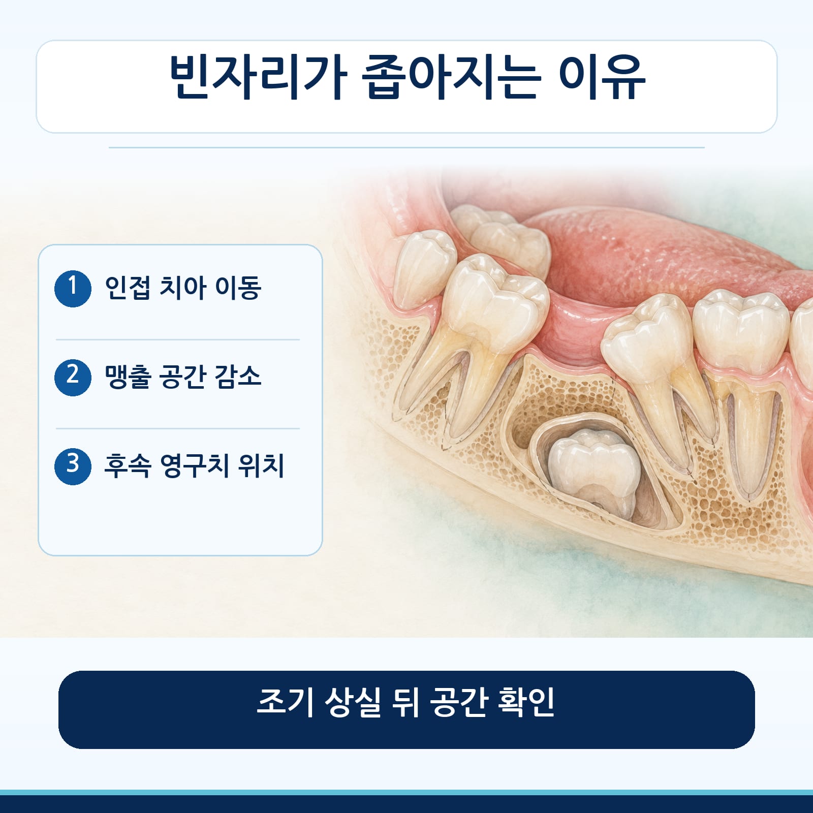 유치 조기 상실 뒤 인접 치아 이동으로 영구치가 나올 공간이 좁아지는 과정을 설명하는 그림