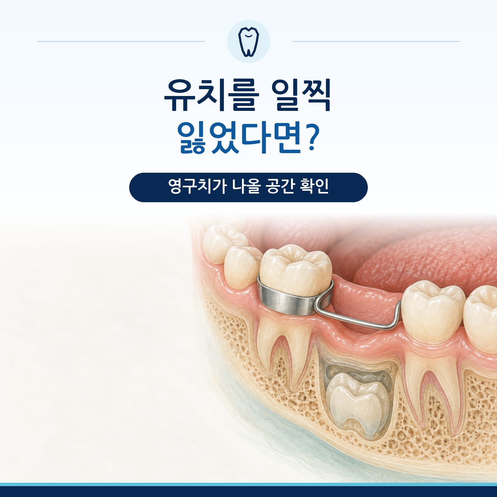 유치 조기 상실 시 공간유지장치의 역할을 설명하는 지축역 치과 칼럼 대표 이미지